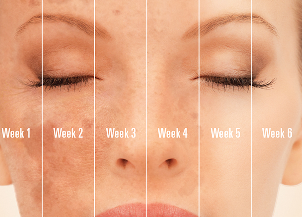 Treatment for Acne